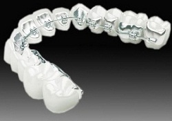 Common questions about orthodontics (braces)