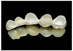 Fixed Dentures types: Ram, that the Metal Bridge, porcelain, porcelain You Metals
