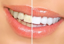 Healthy white teeth bleaching efficiency