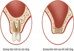 Bone grafting in implant-Things to Know