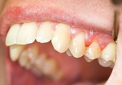 Gum disease - periodontitis