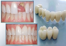 The type of cosmetic porcelain teeth