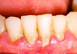 Cao răng và lấy cao răng